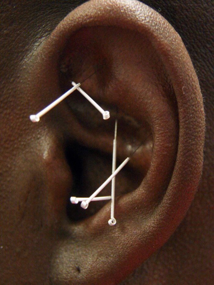 Acupuncture