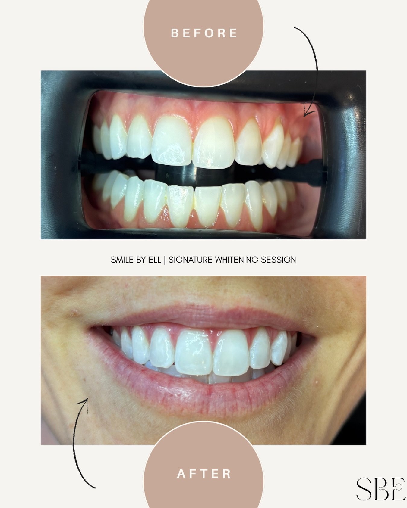 I honestly did not know if I could get this girl any whiter 😂 but three sessions of SBE Signature Teeth Whitening under my powerful @laperlasmiles LED and we are solid for 6 shades lighter 😮&zwj;💨🔥 

#transformation #maitlandteethwhitening #newca
