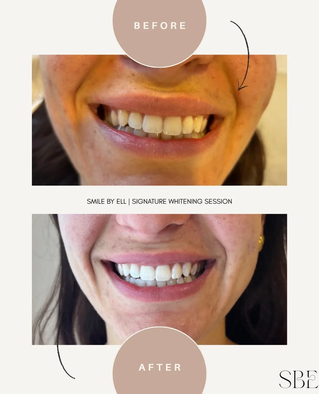 White to whiter 😍😍

#beforeandafter #teethwhitening #inspo #newcastletoothgems