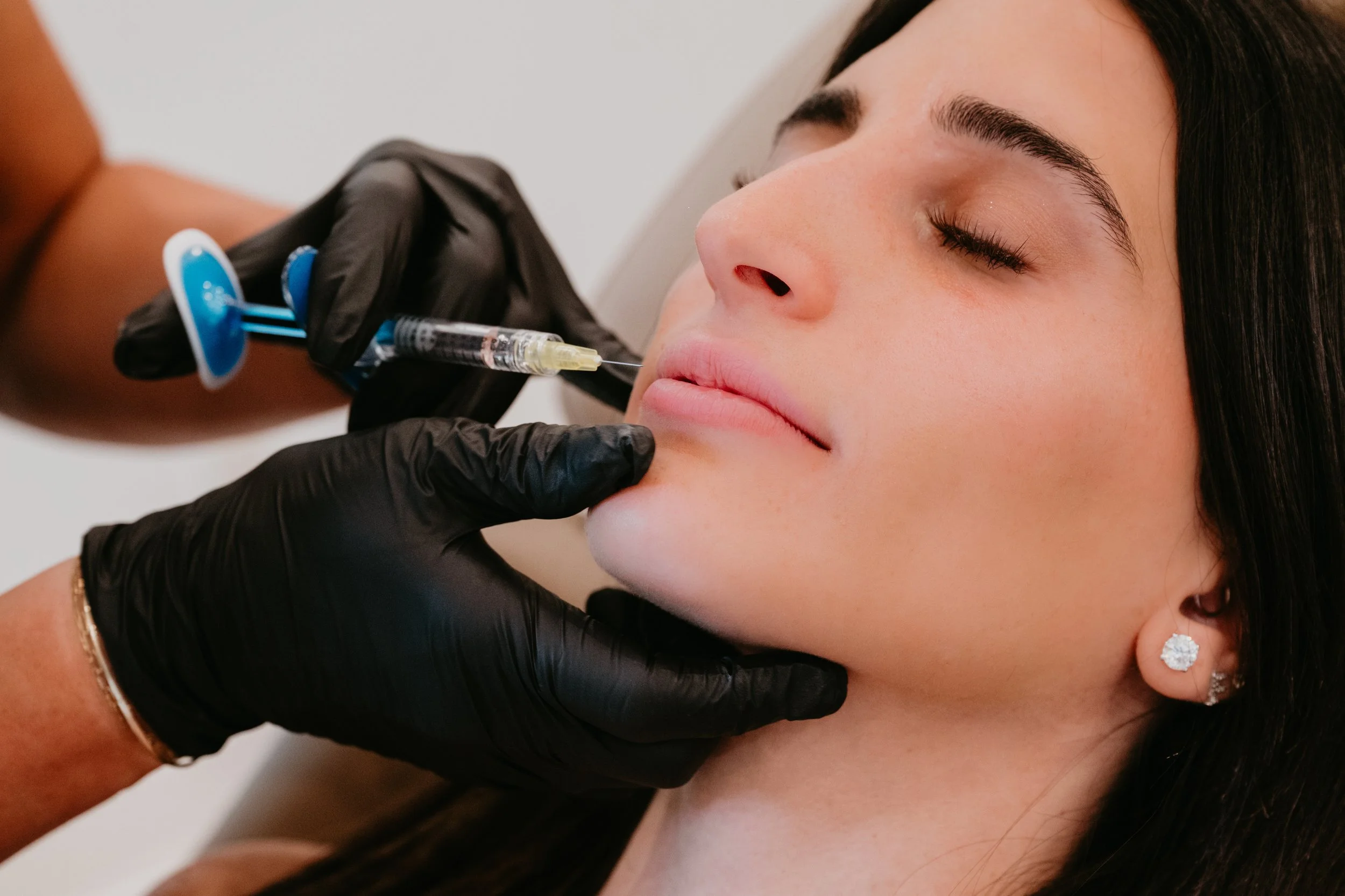 A patient receiving dermal filler near her lips from an aesthetic injector at Estetica Medspa in Las Vegas