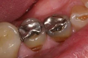 Close-up of three molars with silver amalgam dental fillings.