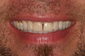 Close-up of a person's smile showing upper and lower teeth with some facial hair.