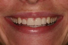 Close-up of a person's smile with white teeth