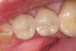 After photo of a dental cavity with tooth colored filling in a molar tooth.