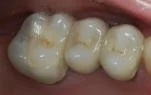 After photo of a dental cavity with dental crown at Taylor Dentistry in Omaha, NE.