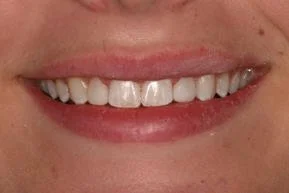 Close-up of a smiling person's mouth showing white teeth.