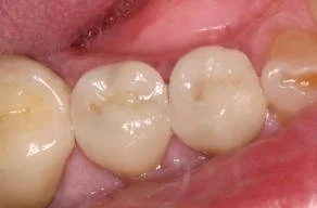 Close-up of four molars in a person's mouth, showing dental fillings on the chewing surfaces.