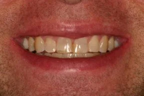 Close-up of a person's mouth showing teeth with wear and discoloration.