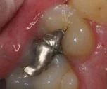 Before photo of a dental cavity with silver amalgam filling in a molar tooth.