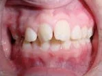 Before photo of a person's teeth and gums showing before orthodontic treatment at Taylor Dentistry in Omaha, NE