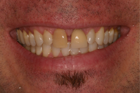 Close-up of a smiling person's mouth showing teeth with some spacing and slight discoloration.