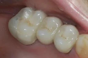 Close-up of a person's molars with dental fillings.