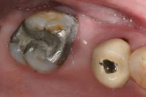 A decayed molar tooth with extensive black and gray decay and cavities.