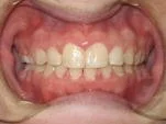Close-up of person's mouth with teeth and gums visible, showing some signs of dental issues.