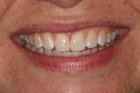 Close-up of a smiling person's mouth showing teeth with slight discoloration and uneven alignment.