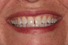 Close-up of a smiling person's mouth showing teeth with some discoloration and unevenness.