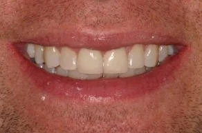 Close-up of a smiling person's teeth and lips.