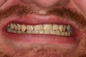Close-up of a person's mouth showing stained, crooked teeth with visible plaque.