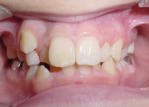 Before photo of a person's teeth and gums showing before orthodontic treatment at Taylor Dentistry in Omaha, NE
