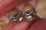 Before photo of a dental cavity with silver amalgam filling in a molar tooth at Taylor Dentistry in Omaha, NE.