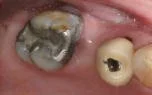 Before photo of a patient who received dental bridge to replace a missing tooth at Taylor Dentistry in Omaha.