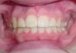 After photo of a person's teeth and gums showing after orthodontic treatment at Taylor Dentistry in Omaha, NE