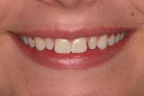 Close-up of a person's smiling mouth showing upper and lower teeth.