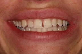 Close-up of a person's smiling mouth showing their teeth.