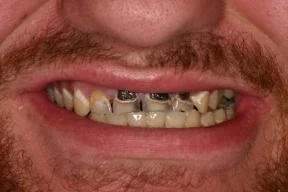 Close-up of a person's mouth showing discolored, decayed teeth with dental crowns.