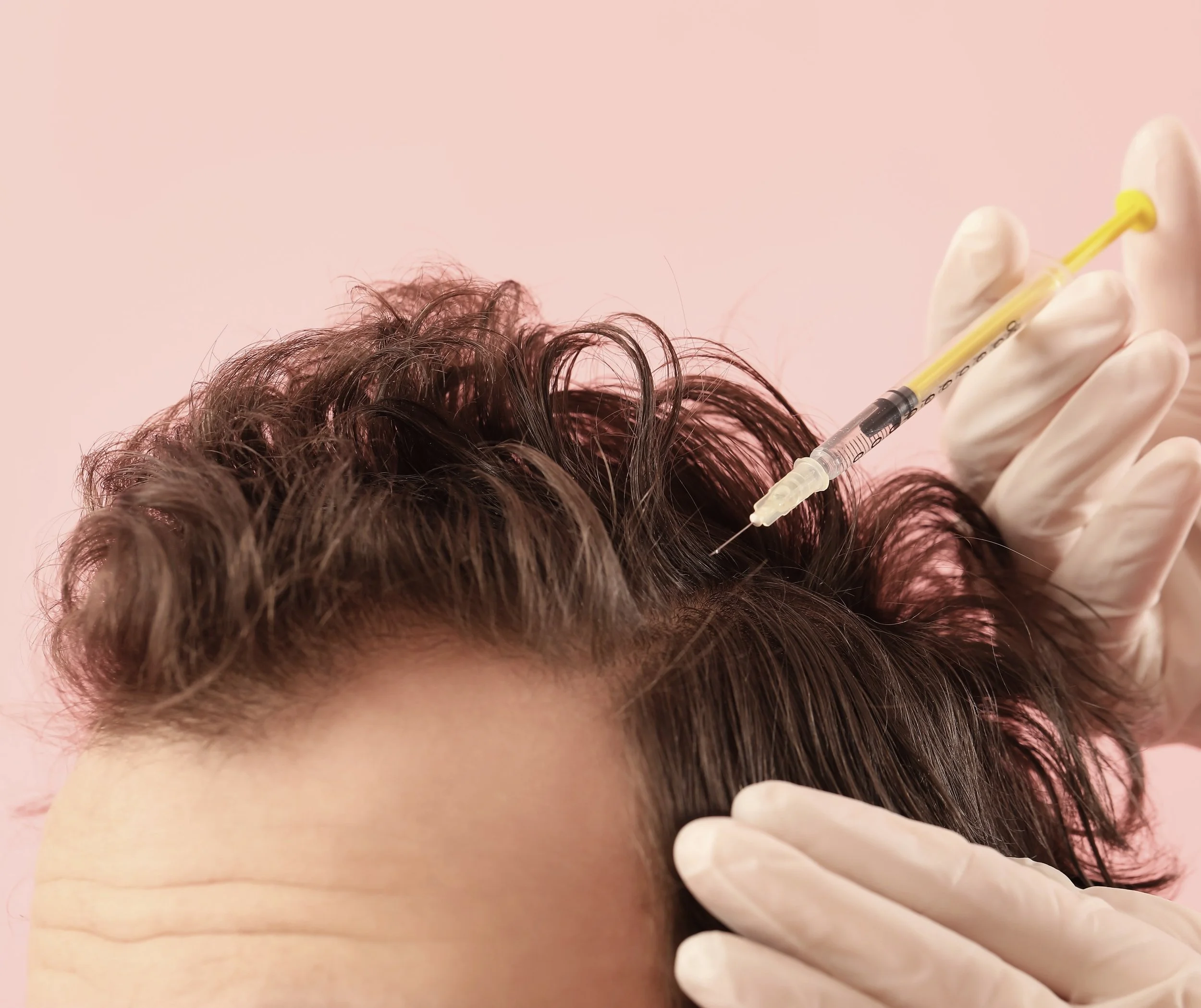 Close-up of a scalp receiving a PRP injection along the hairline to support hair restoration.