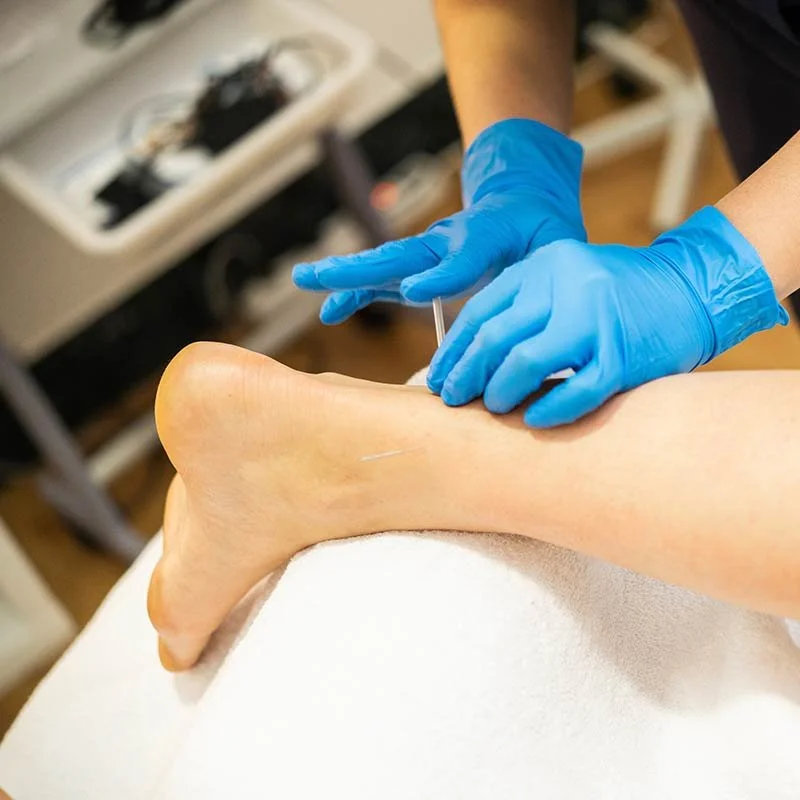 Dry Needling Therapy