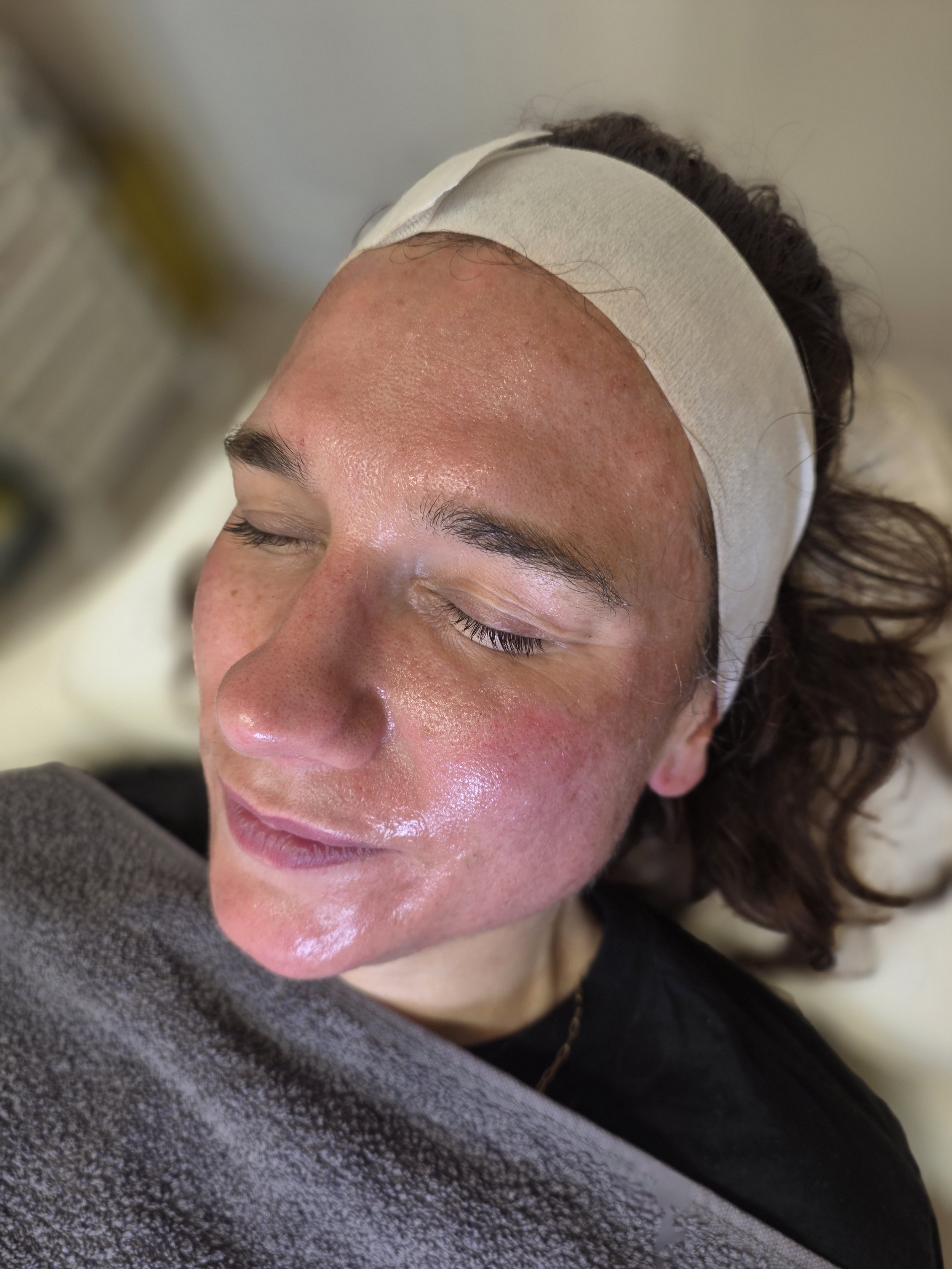 Skin Rejuvenation