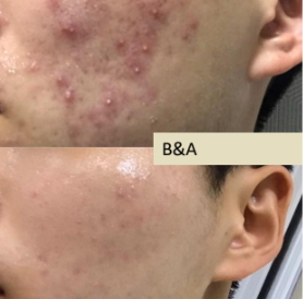 Before and after of  client for the herbal peel 