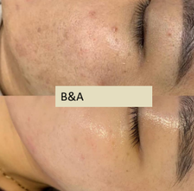 Before and after of  client for the herbal peel 