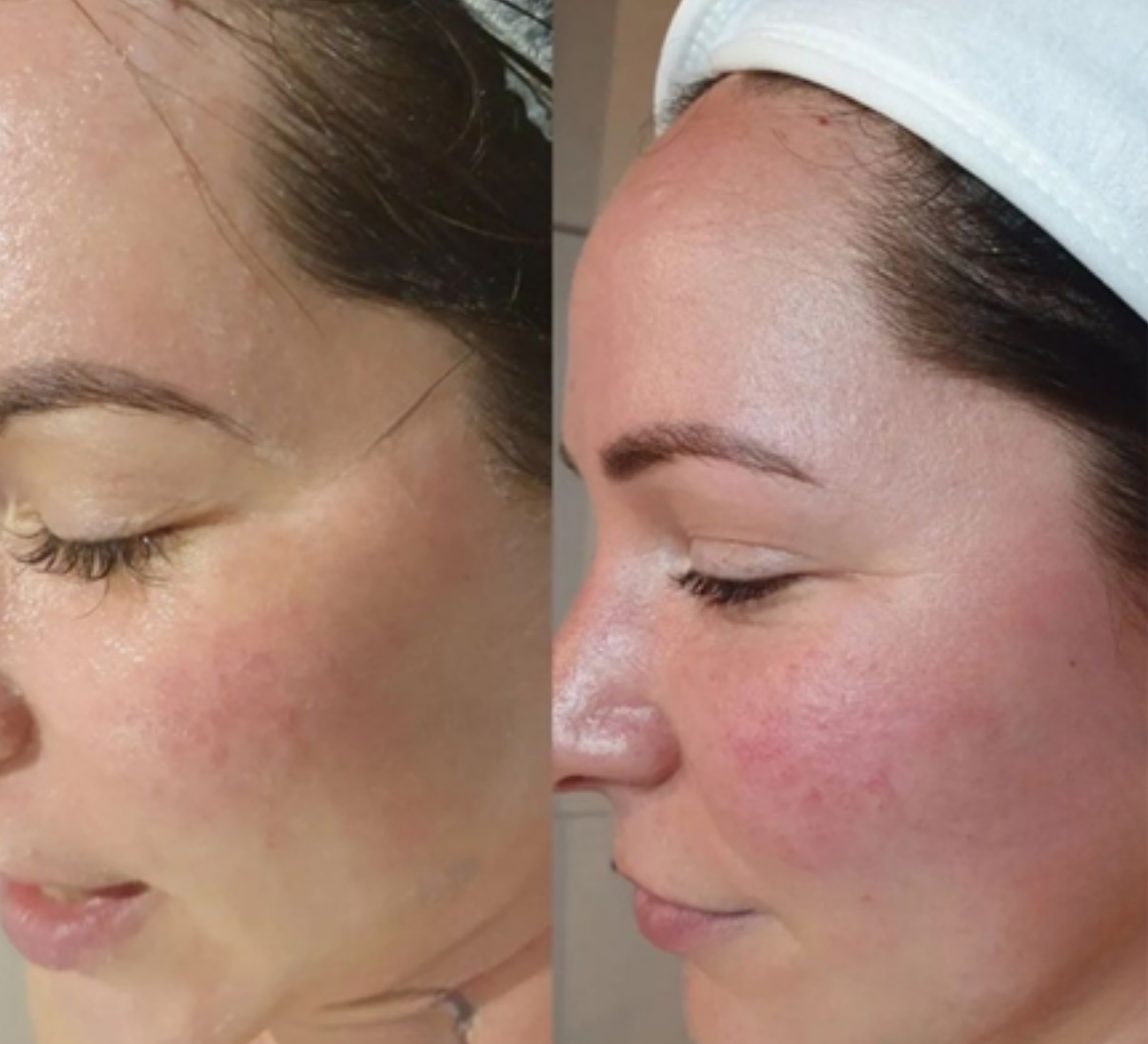 Before and After 4 Treatments 