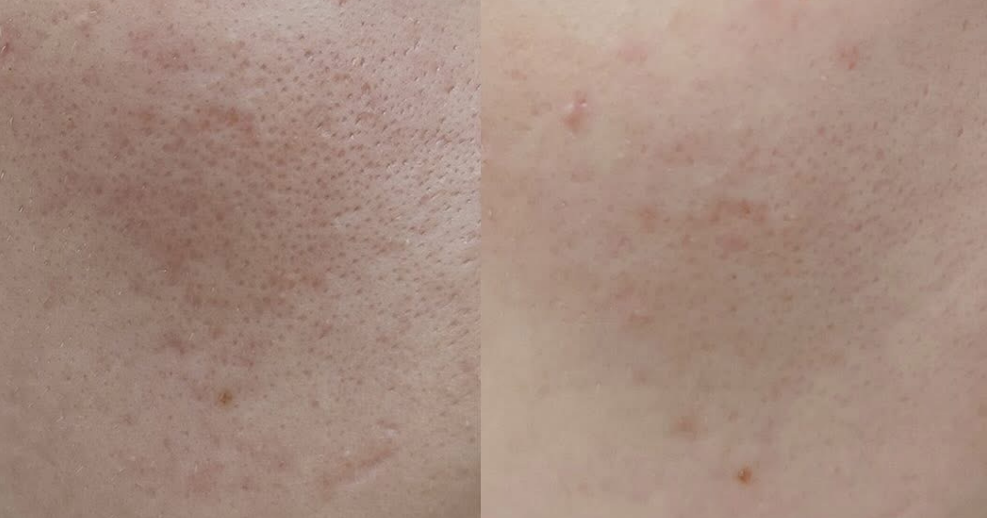 Before and After 1 treatment
