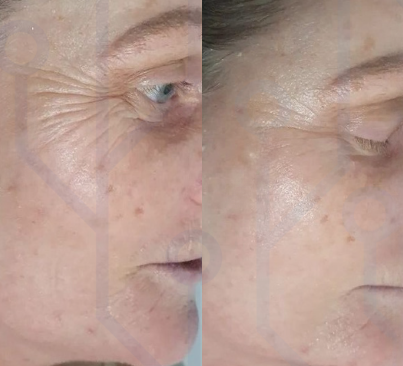 Before and After 2 Treatments 