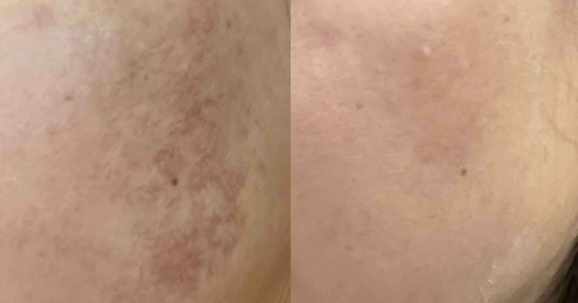 Before and After 1 treatment