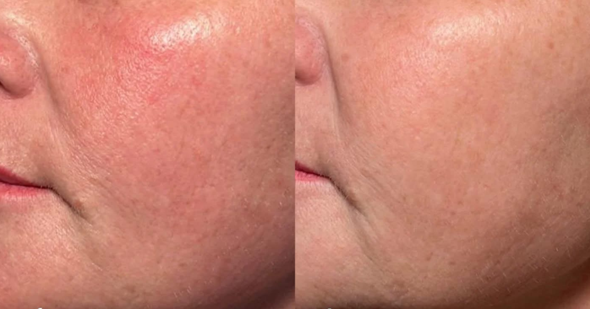Before and After 1 treatment