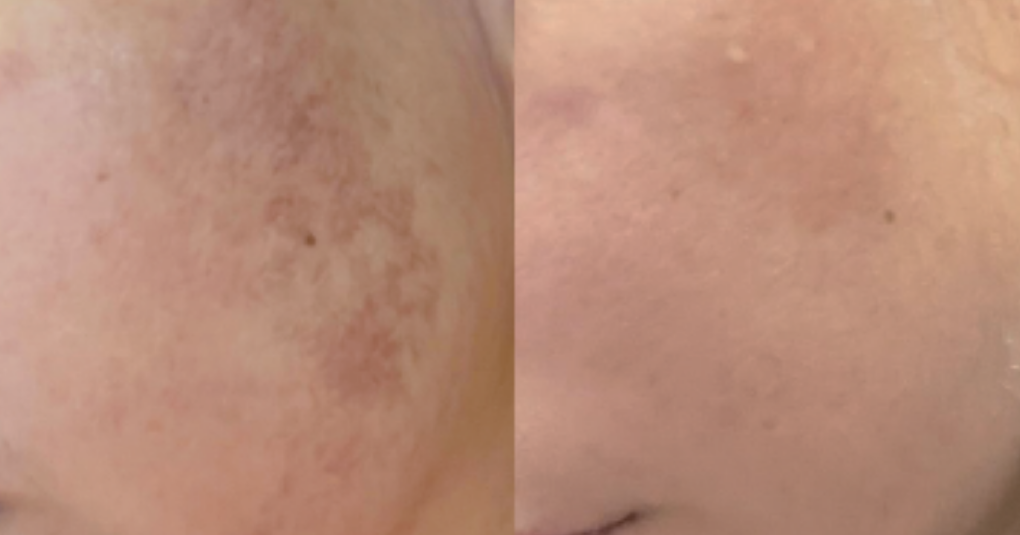 Before and After 1 treatment