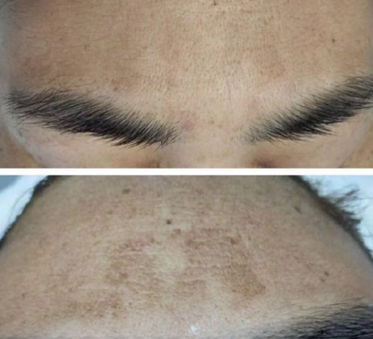 Before and After 4 Treatments 
