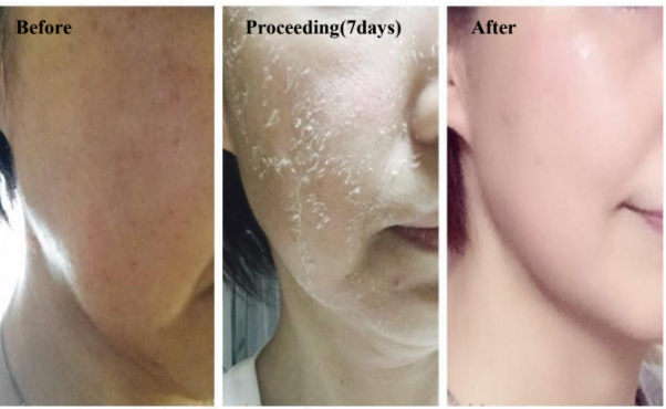 Before treatment, few days after treatment skin is peeling and then  after photo for the herbal peel
