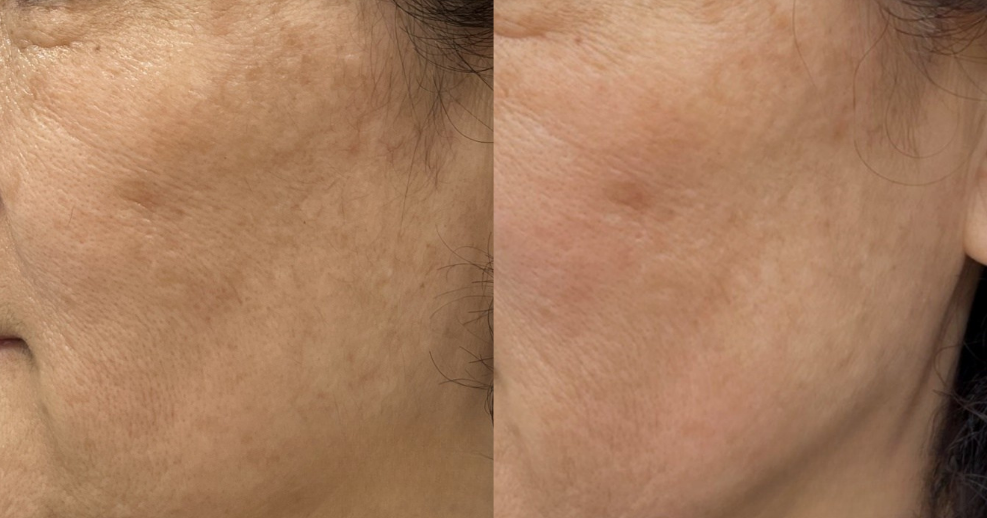 Before and After