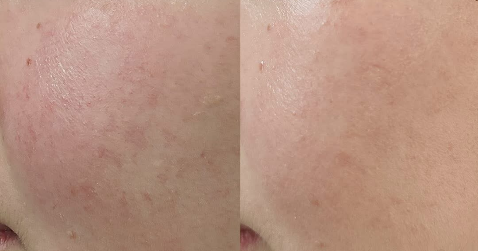 Before and After 2 treatments