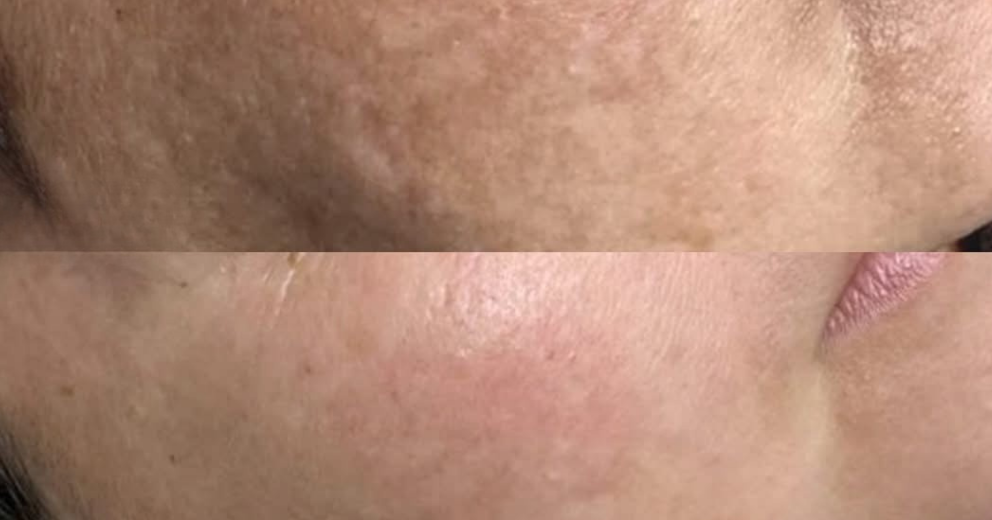 Before and After 1 treatment