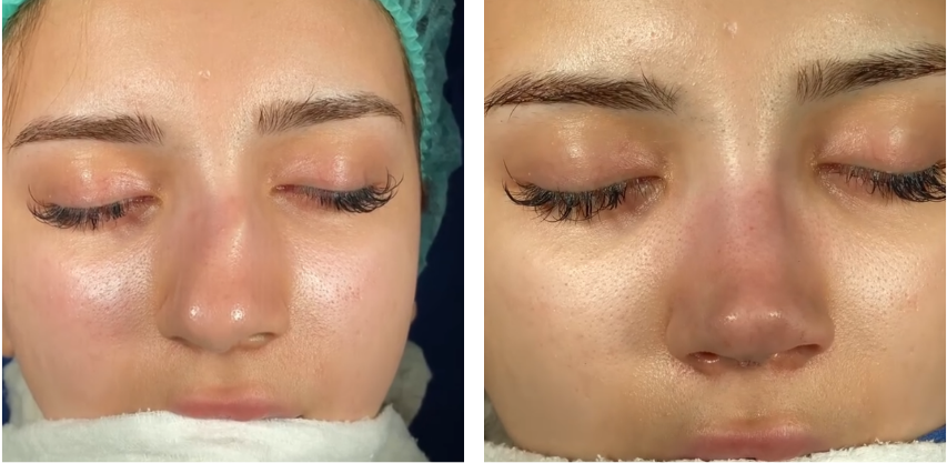 Before and after primary rhinoplasty revision rhinoplasty in Istanbul
