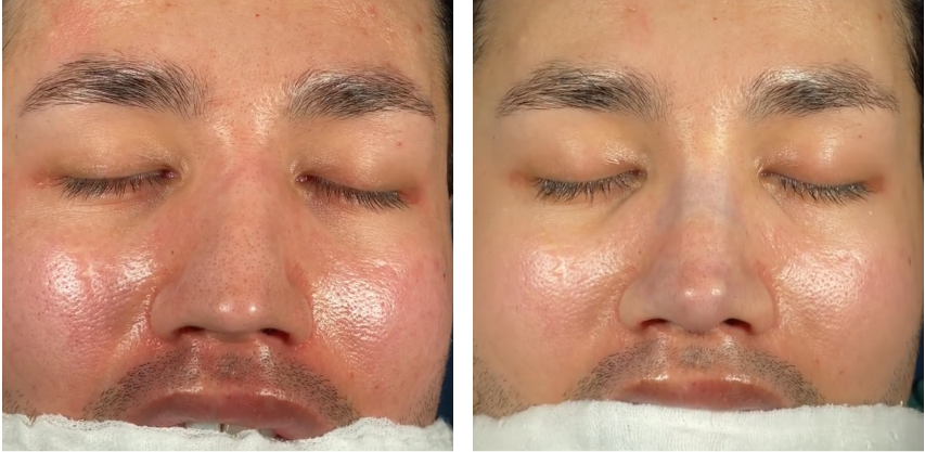 Before and after primary rhinoplasty revision rhinoplasty in Istanbul