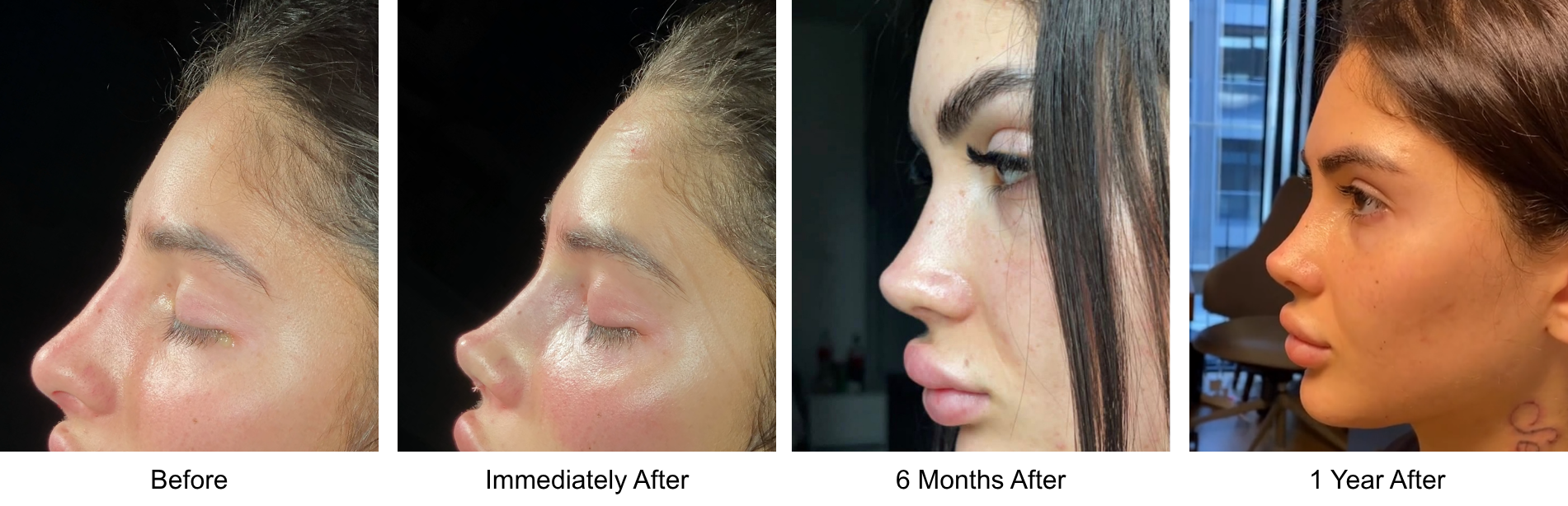 Progress photos of a woman's profile showing changes in her nose over time, labeled from left to right as 'Before', 'Immediately After', '6 Months After', and '1 Year After'.
