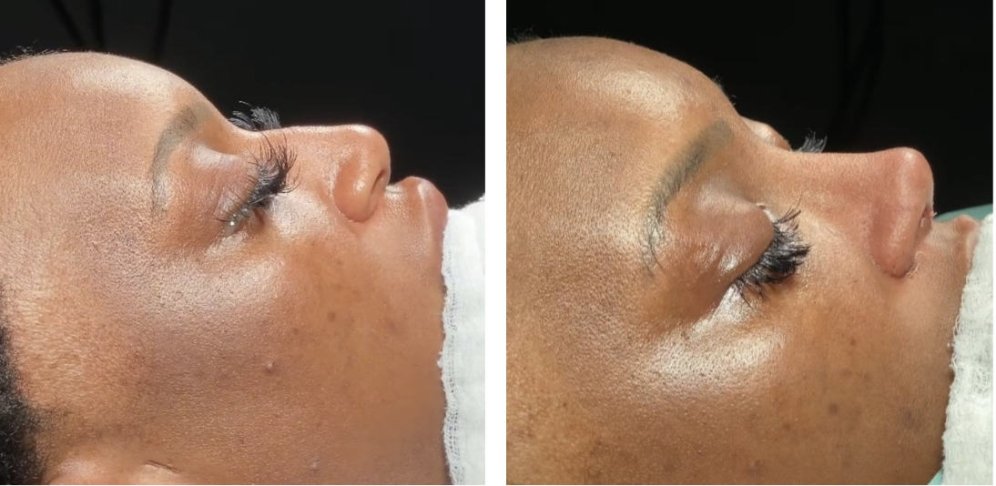 Before and after primary rhinoplasty in Istanbul