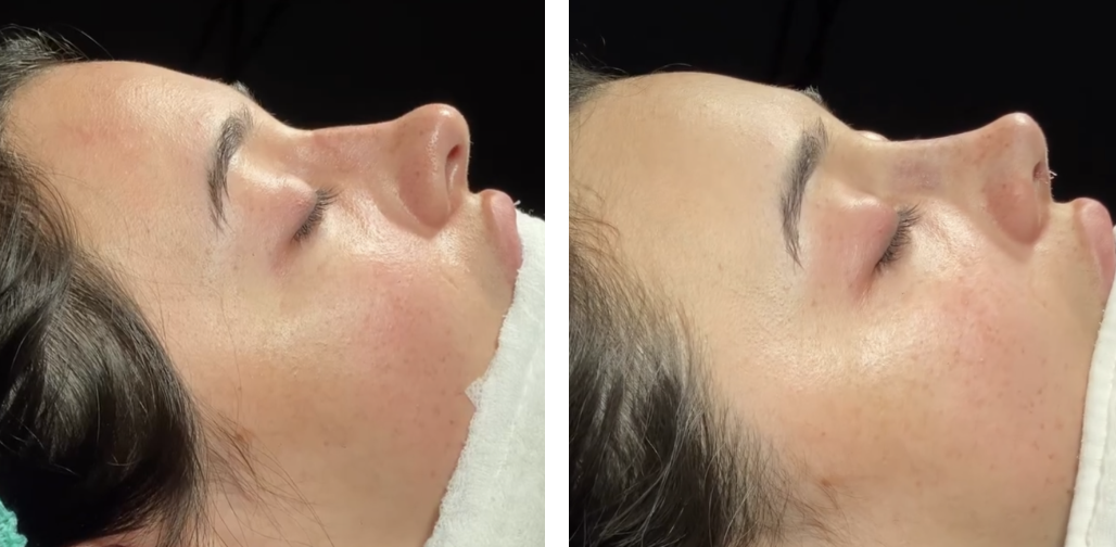 Before and after primary rhinoplasty in Istanbul